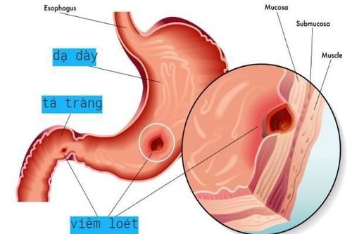 Why do gastric ulcers often recur?