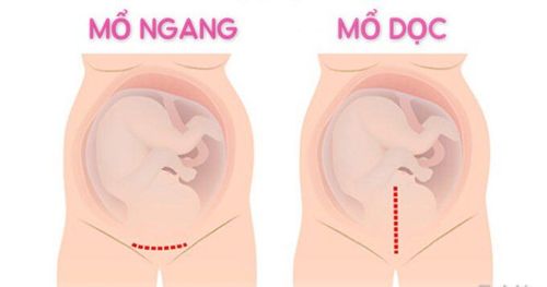 Should a third caesarean section be performed horizontally or vertically?