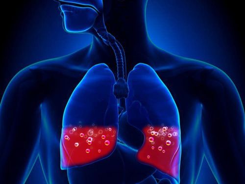 Cardiogenic pulmonary edema: What you need to know