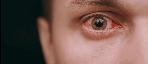 Noninfectious uveitis: Symptoms, diagnosis, and treatment