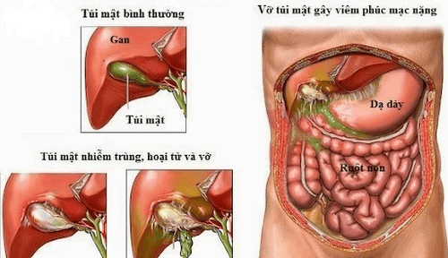 
Nhóm β-lactam và Metronidazol được phối hợp trong điều trị viêm phúc mạc
