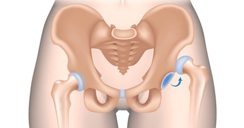 Điều trị bảo tồn trật khớp háng