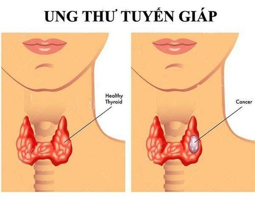 Cervical lymph node dissection in surgically operated thyroid cancer