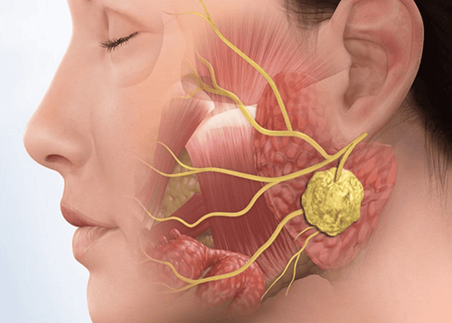 What you need to know about throat cancer