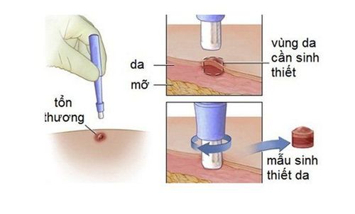 
Sinh thiết da để chẩn đoán bệnh vảy nến thể giọt
