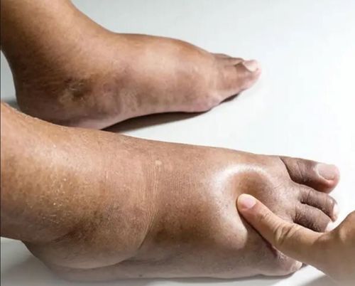 Occurrence of signs of swelling of the feet, swollen feet indicate what disease? Is it related to vascular disease?