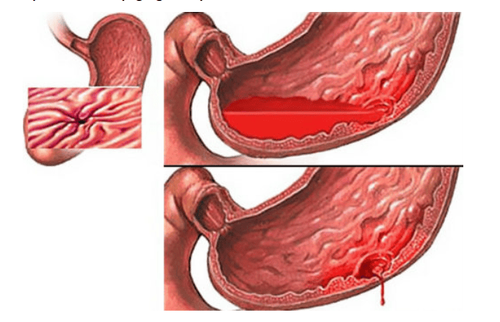 Clinical symptoms of upper and lower gastrointestinal bleeding