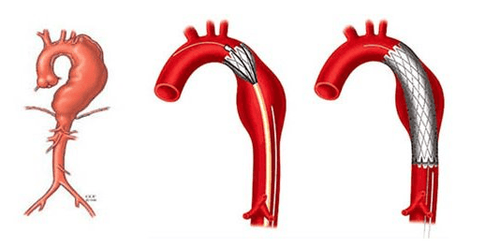 Mechanism of aortic bulge formation