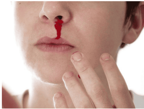 
Frequent nosebleeds - A warning sign of nasopharyngeal fibroids
