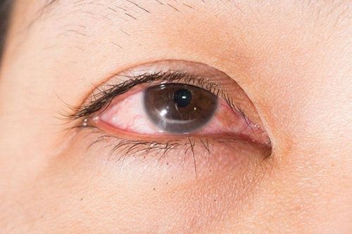 Viêm kết mạc có thể gây ra tắc lệ đạo