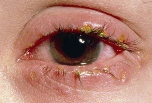 Treatment regimen for allergic conjunctivitis