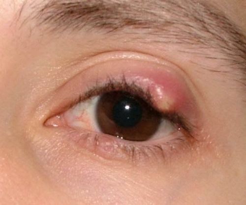 Instructions on how to take care when eyes are chapped and stye