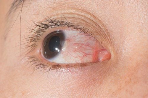 Should conjunctivitis medication be discontinued when an allergy is suspected?