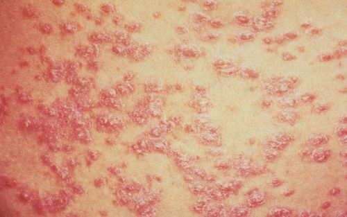 Pustular psoriasis: Symptoms, causes and treatment