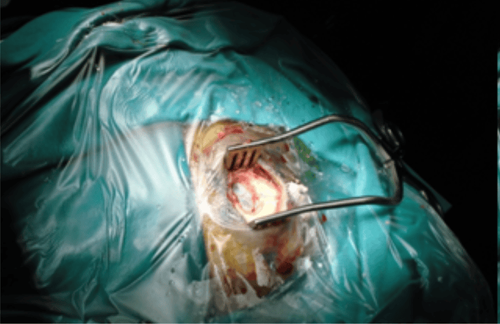 Anesthesia for craniotomy to drain the subdural pus collection