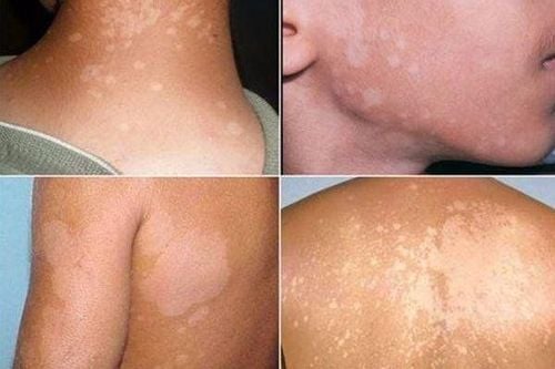 Should ASA solution be used to treat tinea versicolor?