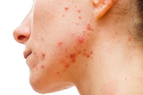 Mistakes when treating acne