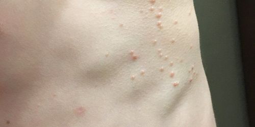 Why is molluscum contagiosum easily confused with other skin diseases?