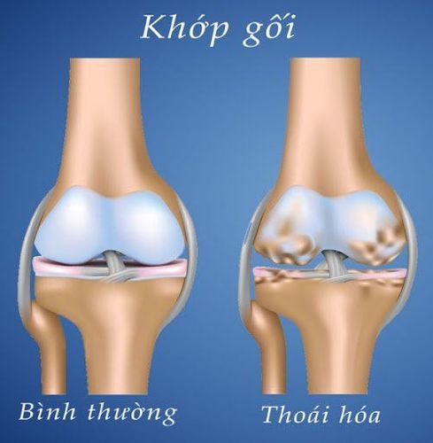 
Thoái hoá khớp gối
