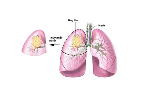 Tìm hiểu về phẫu thuật cắt thùy phổi