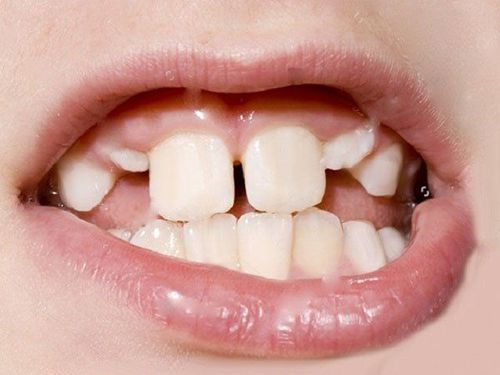 Bé mọc 2 răng cửa thưa và lệch liệu có cách nào khắc phục không?