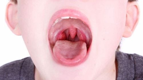 Sore throat, swollen lymph nodes in the neck, tongue, dangerous?