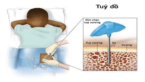 Xét nghiệm tủy có tìm ra nguyên nhân gây sưng tấy khớp tay, chân không?