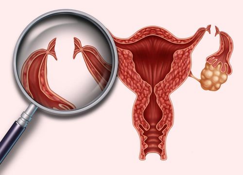 Thắt ống dẫn trứng và u cổ tử cung có thể có con được không?