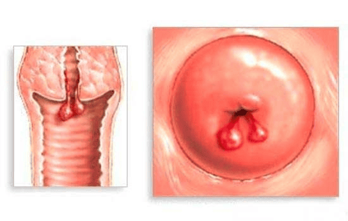 Sau sinh xuất hiện polyp cổ tử cung nên điều trị thế nào?