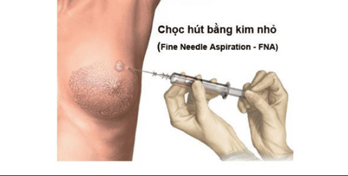 
Chọc hút bằng kim nhỏ (FNA) giống với quy trình lấy mẫu máu
