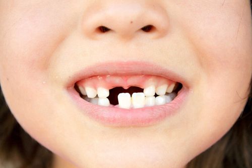 Trẻ rụng răng cửa sau 2 tháng chưa mọc có cần đi khám không?