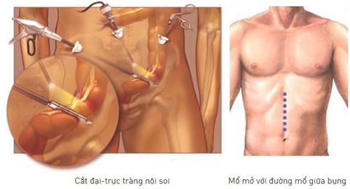 
Kỹ thuật cắt đại tràng nội soi và mổ mở đường mổ giữa bụng
