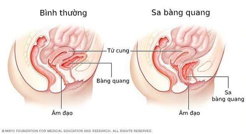 
Bệnh sa bàng quang
