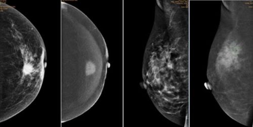 Contrast-enhanced mammogram