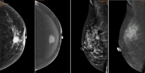 Chụp X-quang vú có thuốc cản quang