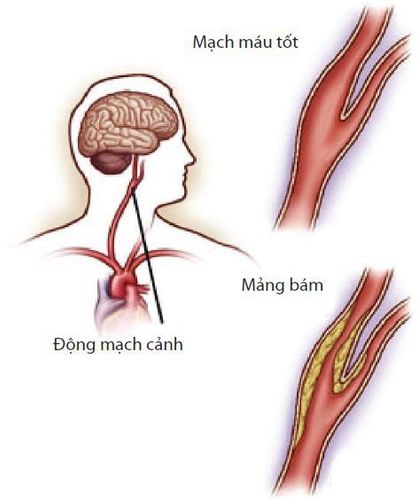 
Bệnh lý động mạch cảnh
