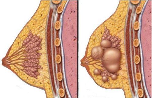 Breast cyst aspiration under ultrasound guidance