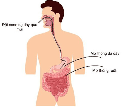 
Mở thông dạ dày là thủ thuật tạo ra lỗ thông trực tiếp từ ngoài vào trong lòng dạ dày để nuôi dưỡng người bệnh
