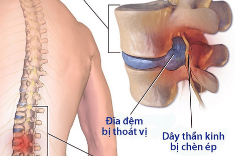 
Nguyên nhân gây đau lưng có thể liên quan tới thoát vị đĩa đệm gây chèn ép rễ hoặc viêm khớp liên mấu
