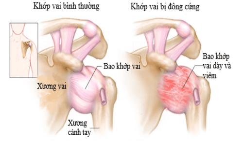 
Viêm quanh khớp vai thể đông cứng là thể bệnh hay gặp, đứng hàng thứ hai sau viêm quanh khớp vai thông thường
