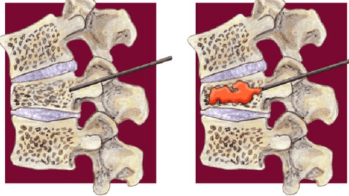 Pouring spinal cement under the enhanced X-ray