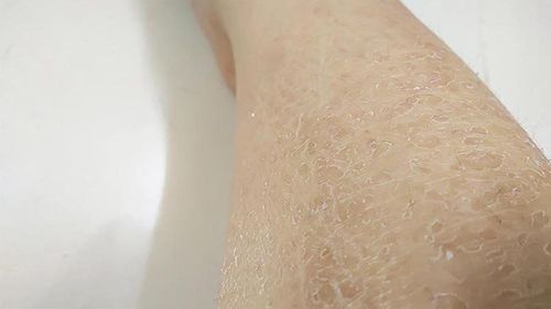 Fish scale skin disease: Causes, symptoms