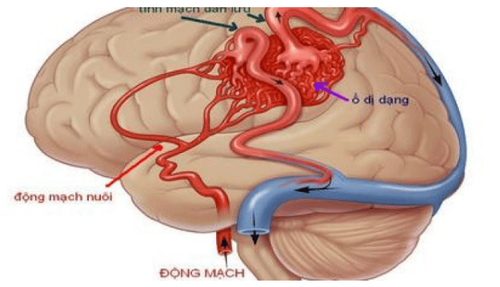 Arteriovenous catheterization: causes, diagnosis, treatment