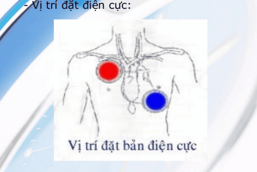 
Kích thích não sâu bằng cách đặt điện cực giúp cải thiện triệu chứng cho người bệnh.
