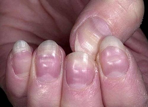 Why do your nails look weird?