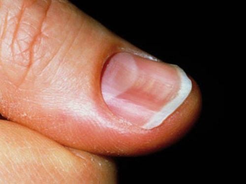 Spoon-shaped concave nails: Causes and mechanisms of pathogenesis