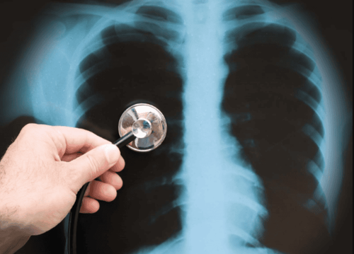 Chest X-ray to diagnose pulmonary embolism