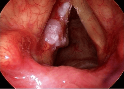 Symptoms of early stage laryngeal cancer