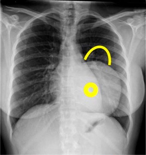 Common mediastinal diseases | Vinmec