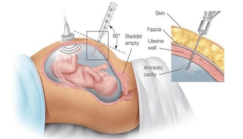 How is amniocentesis and amniotomy performed?